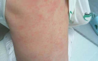 儿童退烧三天后为何再次发烧？是反复感染还是疾病未愈？