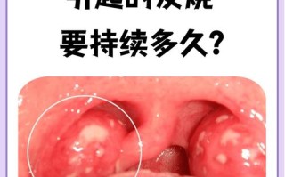 备孕期扁桃体发炎发烧会影响怀孕吗？需要用药治疗吗？