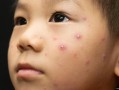 儿童水痘初期症状图片有哪些典型表现？如何通过图片辨别早期水痘？