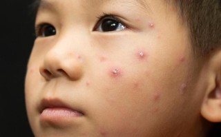 儿童水痘初期症状图片有哪些典型表现？如何通过图片辨别早期水痘？