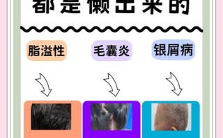 孕期患头癣，用药安全与胎儿健康如何兼顾？