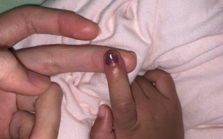 新生儿手指甲根部发青