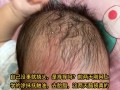 如何正确安全去除新生儿头上的顽固胎垢？