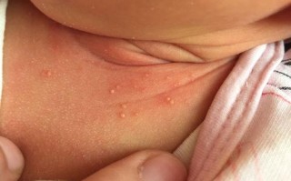 新生儿脖子白色分泌物是正常胎脂还是需警惕的皮肤病？