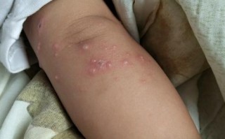 新生儿黄水泡症状图片是什么样的？需要警惕哪些疾病风险？