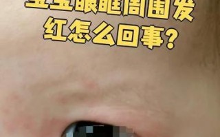 儿童眼圈发红是过敏还是疾病信号？家长该如何应对与护理？