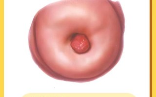 孕期宫颈息肉到底该不该摘除？摘除会不会伤害胎儿？