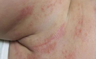 儿童湿疹反复发作，究竟是什么因素在背后作祟？