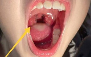 儿童扁桃体发炎图片能准确判断病情吗？不同症状该如何区分？