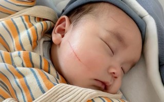 新生儿剪指甲不慎剪到肉怎么办？如何正确处理与预防？