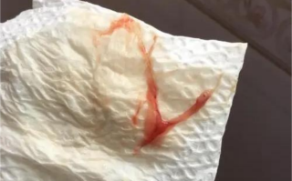 孕期宫颈糜烂出血，是正常现象还是危险信号？