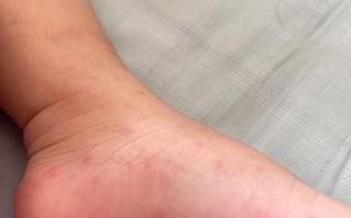 儿童血液病早期症状隐匿，家长该如何识别这些容易被忽略的危险信号？