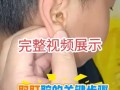 儿童耵聍栓塞怎么取出？在家能操作吗？需要去医院吗？
