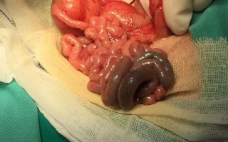 新生儿十二指肠闭锁图能直观看出哪些关键畸形特征？