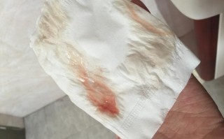 易孕期同房白带有血丝