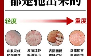 孕期为何易遭湿疹突袭？激素变化、免疫系统波动如何共同作祟？
