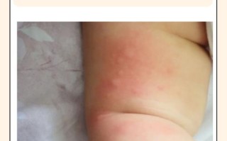 儿童皮肤红点且瘙痒不止，究竟是什么原因引起的？