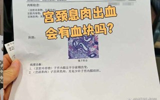 孕期宫颈息肉引发便秘出血，该如何区分是息肉还是其他问题？