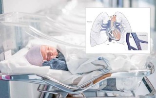 新生儿肺动脉高压治疗有哪些关键难点与最新突破？