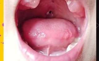 3mm新生儿唇裂照片能看清哪些细节？是否会影响未来修复？