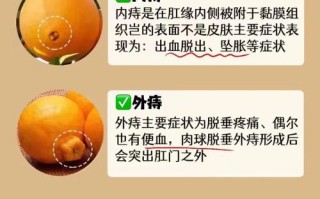 孕期痔疮犯了怎么办？这5个安全缓解方法能试试吗？