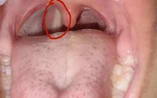 新生儿嗓子有痰正常吗？是生理现象还是疾病信号？需不需要干预处理？