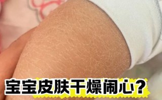 新生儿脸起干皮怎么办