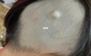 新生儿头皮里的疙瘩是正常生理现象还是疾病信号？需要警惕吗？