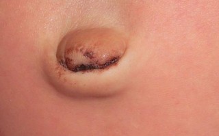 新生儿肚脐血痂脱落时流血正常吗？该怎么护理才能避免感染？