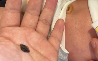 新生儿肚脐脱落过程中会感到疼痛吗？家长该如何正确护理避免不适？