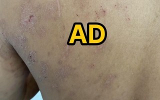 儿童特异性皮炎反反复复，到底该怎么治才能好得快还不复发？