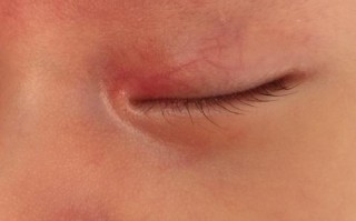 新生儿眼珠旁边出现红色是何原因？需警惕哪些眼部问题？