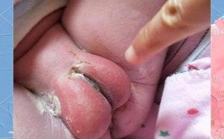 女新生儿私处发红图片是正常现象吗？需要就医处理吗？