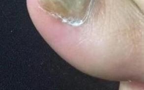 孕期指甲发黄怎么回事