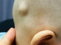 新生儿颅内囊肿常见吗？出现后需要立即治疗吗？