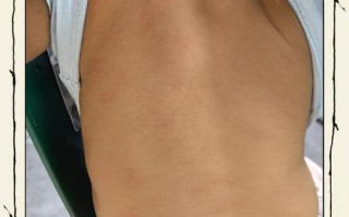 儿童对牛奶过敏会有哪些典型症状？家长该如何早期识别与应对？