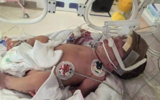 36周早产儿患肺炎，该如何科学护理才能降低风险？