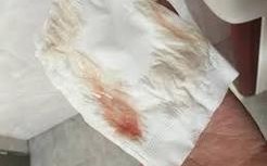 孕期大便带白色分泌物是感染还是正常孕期变化？需警惕哪些妇科或肠道问题？