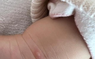 10天新生儿手上长水泡是正常现象吗？需要警惕哪些疾病风险？