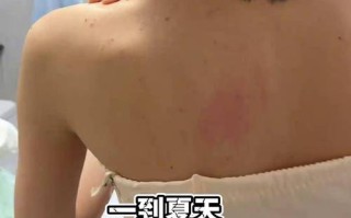 怀孕期间前胸后背长痘是激素变化还是皮肤问题？