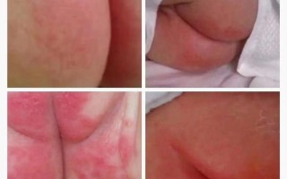 新生儿屁股红是尿布疹还是护理不当？红肿、破皮怎么办？