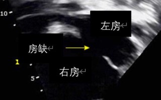 2mm新生儿房缺需要干预吗？能自行闭合吗？对生长发育有影响吗？