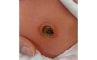 新生儿肚脐眼有臭味是感染了吗？该怎么处理和预防？