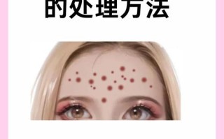 儿童额头痘痘怎么快速消除？
