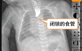 新生儿消化道造影危害