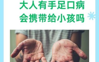 儿童手足口病会传染给大人吗？