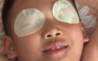 儿童做后巩膜加固术安全吗？效果能维持多久？有没有更优的近视控制方案？