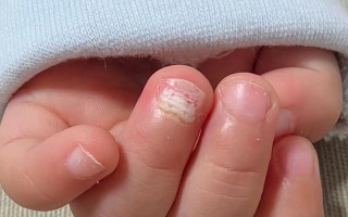儿童指甲真菌感染图片有哪些典型症状？如何判断是否需要就医治疗？