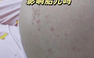 怀孕期间为何总被湿疹缠上？孕期湿疹的诱因与应对方法有哪些？