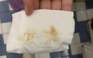 孕期下面流黄黄的东西，是正常分泌物还是感染信号？需要警惕哪些异常情况？